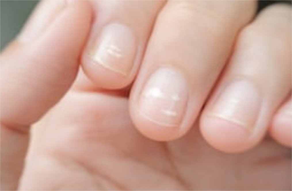 Je ne peux m’empêcher de ronger mes ongles 1 Je ne peux m’empêcher de ronger mes ongles 1